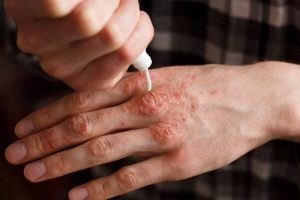 6 naturlige cremer til at bekæmpe psoriasis