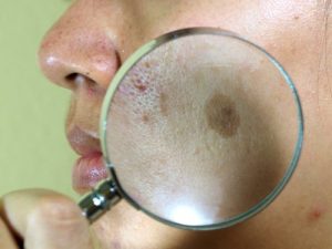 7 naturlige ansigtsbehandlinger mod solpletter