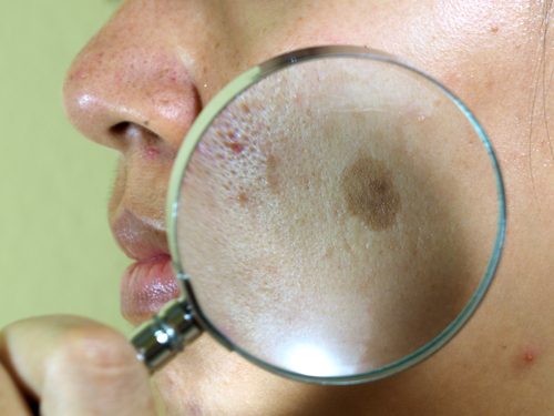 7 naturlige ansigtsbehandlinger mod solpletter