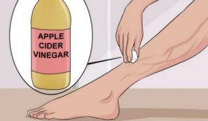 Du kan behandle åreknuder med 3 naturlige ingredienser!