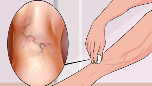 Aareknuder på benene