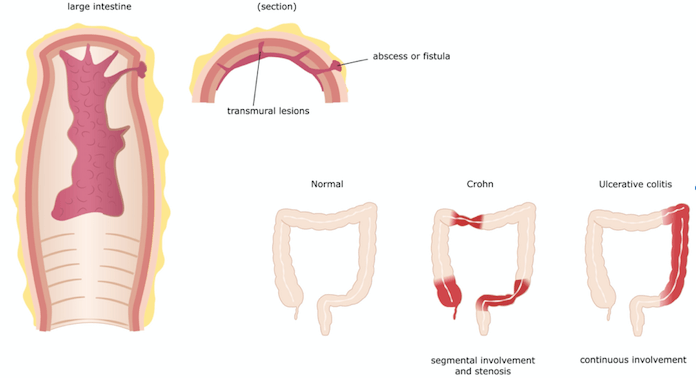 Behandling af crohns kan være svært.
