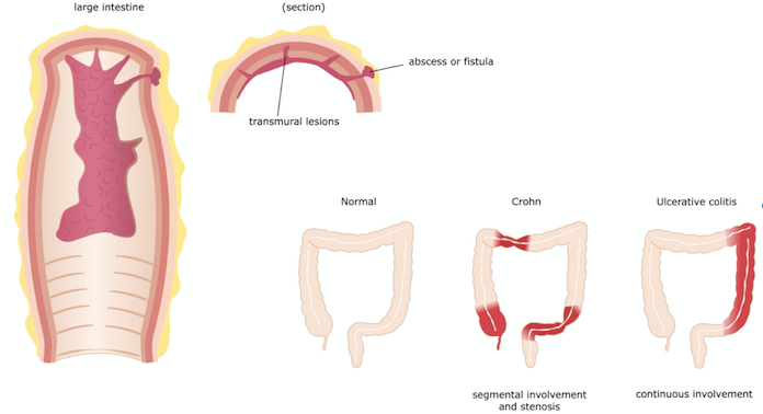 Crohns sygdom