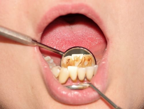 Sådan fjernes tandsten på en naturlig måde