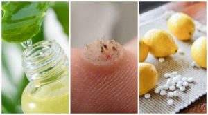 Kom af med vorter med disse 6 kraftfulde midler