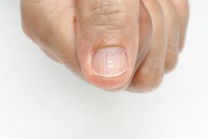 Hvordan man slipper af med fingerneglelinjer