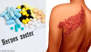 Helvedesild symptomer og diagnotiske fakta at kende til