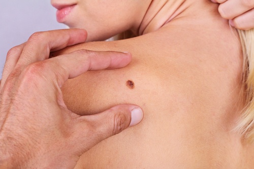6 hudkræftsymptomer du ikke bør ignorere