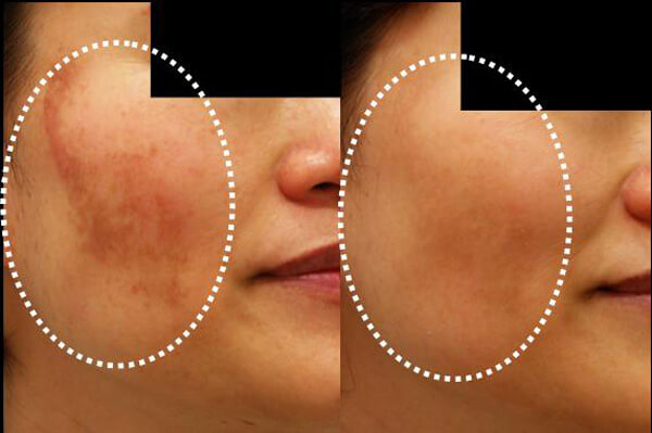 Reducer hud misfarvninger med disse 5 hjemmelavede masker