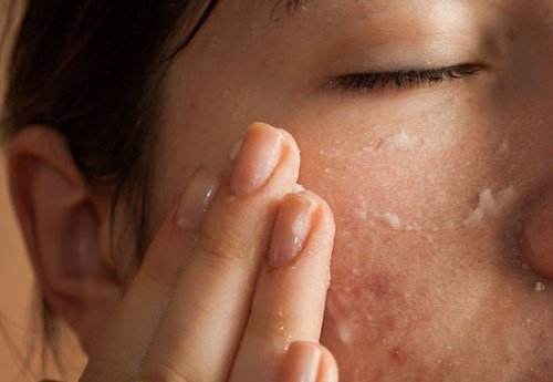 Aspirin mod acne