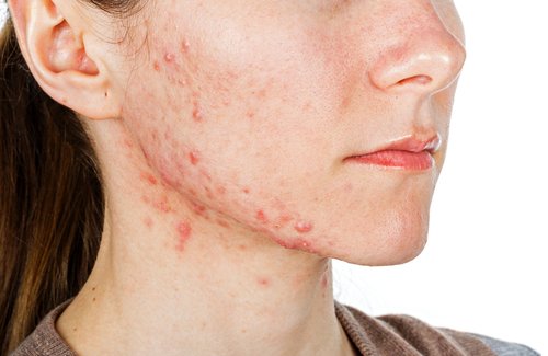 Akne på huden i ansigtet