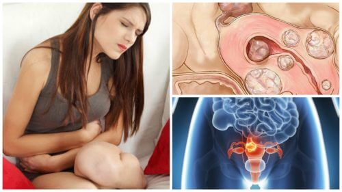 5 fakta om muskelknuder i livmoderen, som alle bør kende