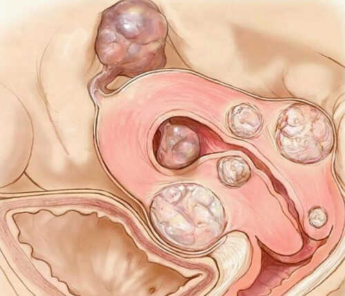 Billede af muskelknuder i livmoderen