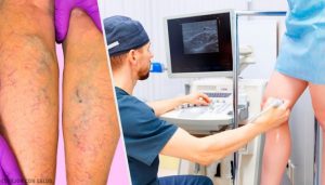 Naturlige topiske og orale behandlinger mod åreknuder