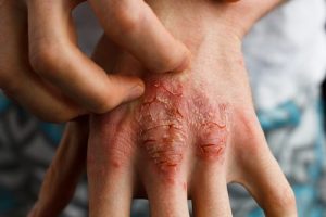 Hvordan du kan behandle psoriasis