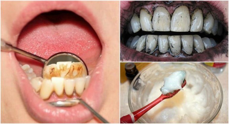 3 effektive hjemmemidler til at fjerne tandsten