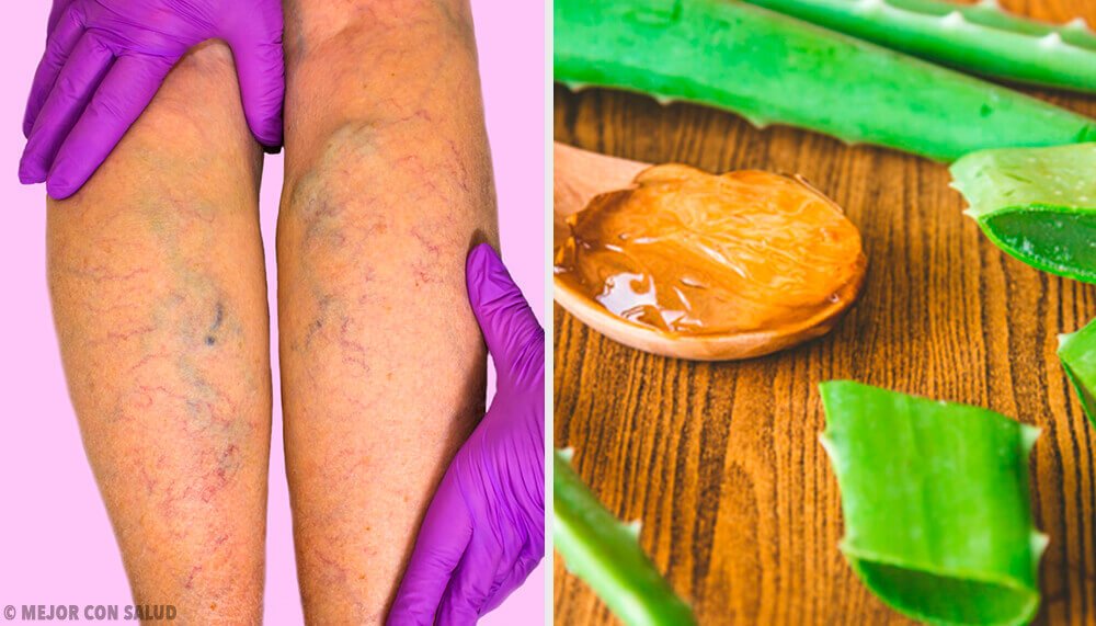 Du kan helbrede åreknuder med dette aloe vera middel