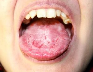 Hvad er candidiasis?
