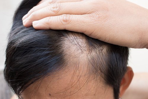 6 naturlige midler mod skaldethed, du skal prøve