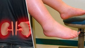 Hvad forårsager væskeretention