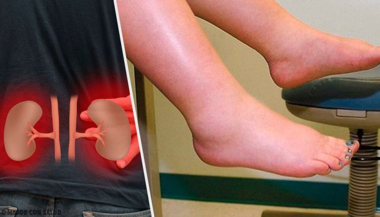 Nyrer er en del af årsagen til væskeophobning