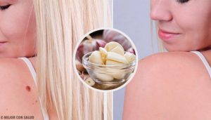 9 måder til at fjerne vorter hurtigt