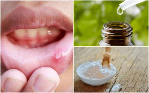 6 naturlige midler mod blister i munden