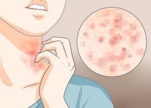 Tre hjemmelavede salver, der lindrer kløe fra fnat