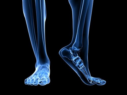 Knogle i fod viser plantar fasciitis
