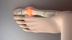 Otte eksempler på mad, der kan sænke urinsyre