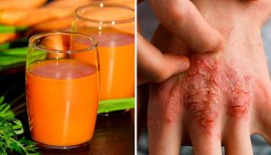 Sådan kan du lindre psoriasis med disse 7 naturlige midler