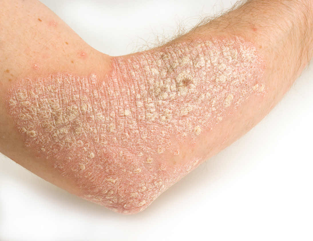 Person med psoriasis - lindre symptomerne paa psoriasis