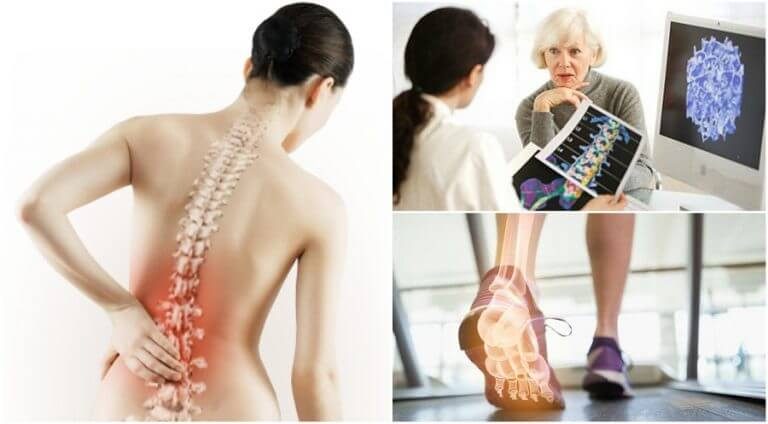 6 ting du bør vide om osteoporose