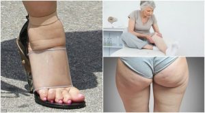 5 almindelige symptomer på ødemer