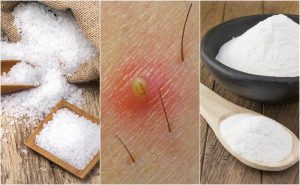 5 naturlige løsninger mod indgroet hår