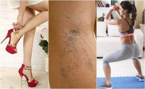 10 tips til at undgå åreknuder