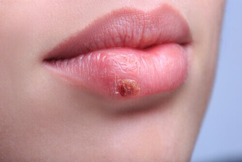 Kvinde med herpes paa laeben - almindelige infektioner