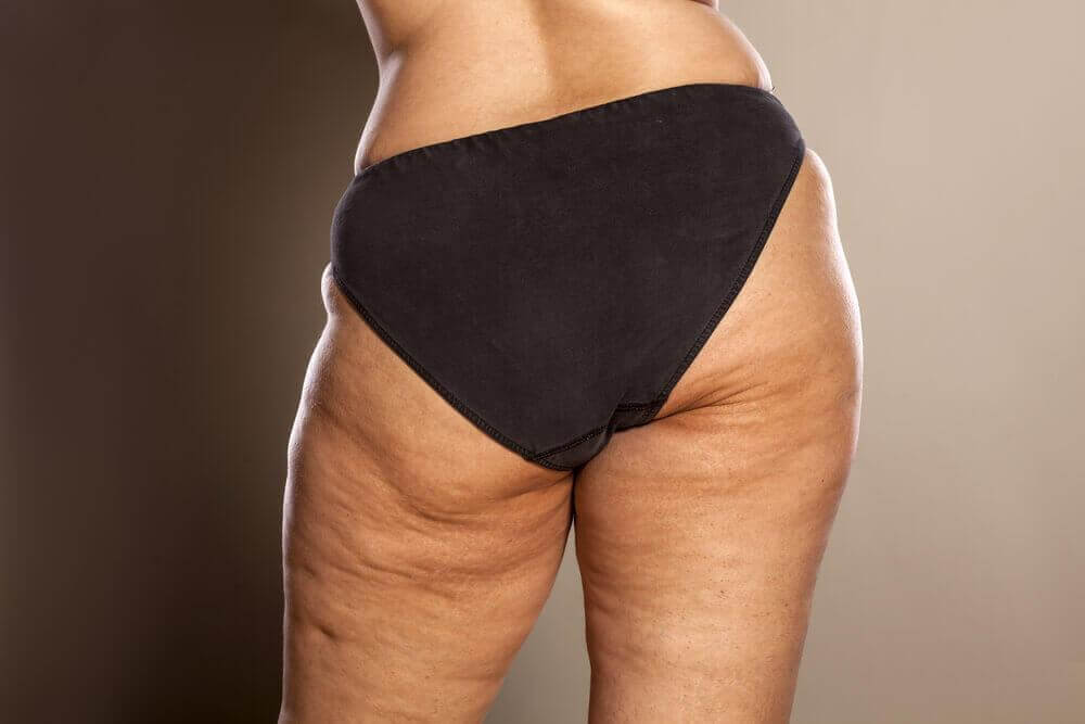 Kvinde med cellulitis