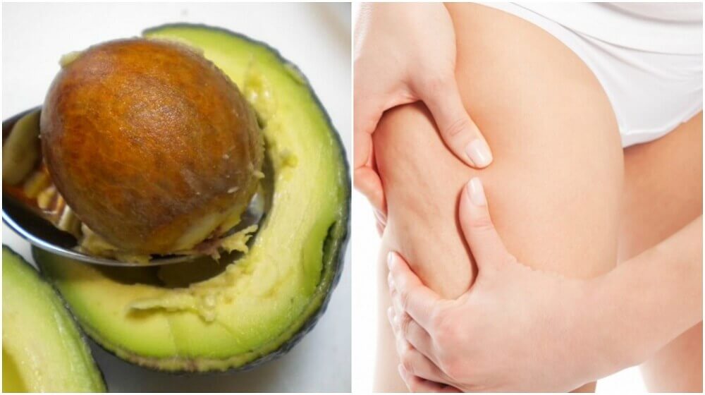 Sådan bruges avocadokerner til behandling af cellulitis