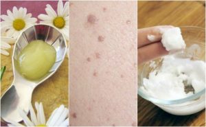 Fem behandlinger mod vorter