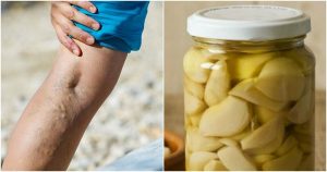 Hjemmemedicin med appelsinjuice mod åreknuder