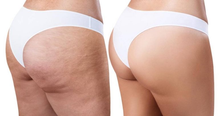 Kom af med cellulitis med disse nemme midler