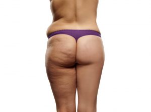 Den perfekte anti cellulitis kostplan