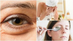 6 naturlige metoder til at reducere poser under øjnene