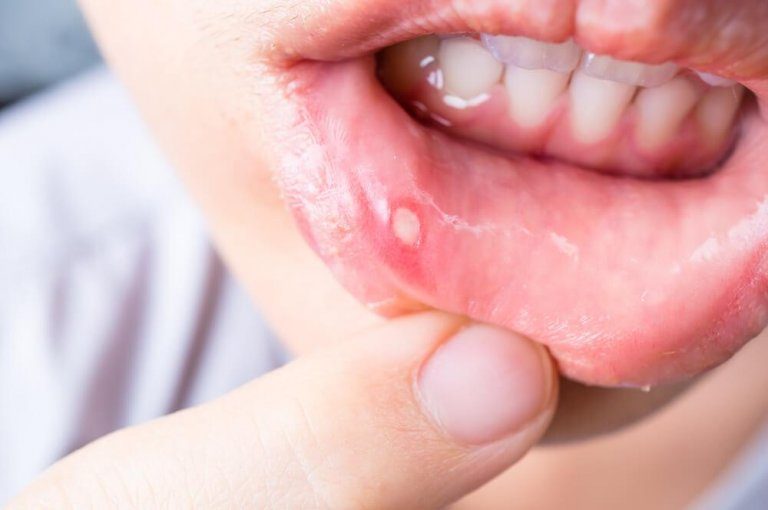 5 narturlige lægemidler til behandling af tandkødsbetændelse