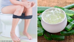 Behandling af hæmorider