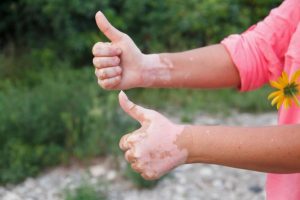 Det kan du spise, hvis du har en autoimmun sygdom