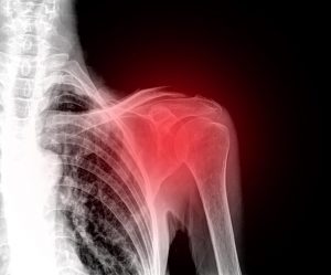 Sådan kan du lindre skuldersmerter med naturmedicin