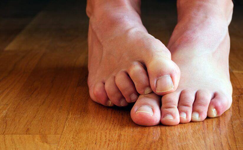 Taeer med neglesvamp