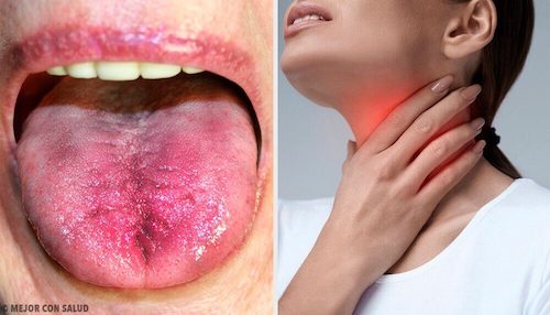 6 måder du kan vide om du har plak i halsen